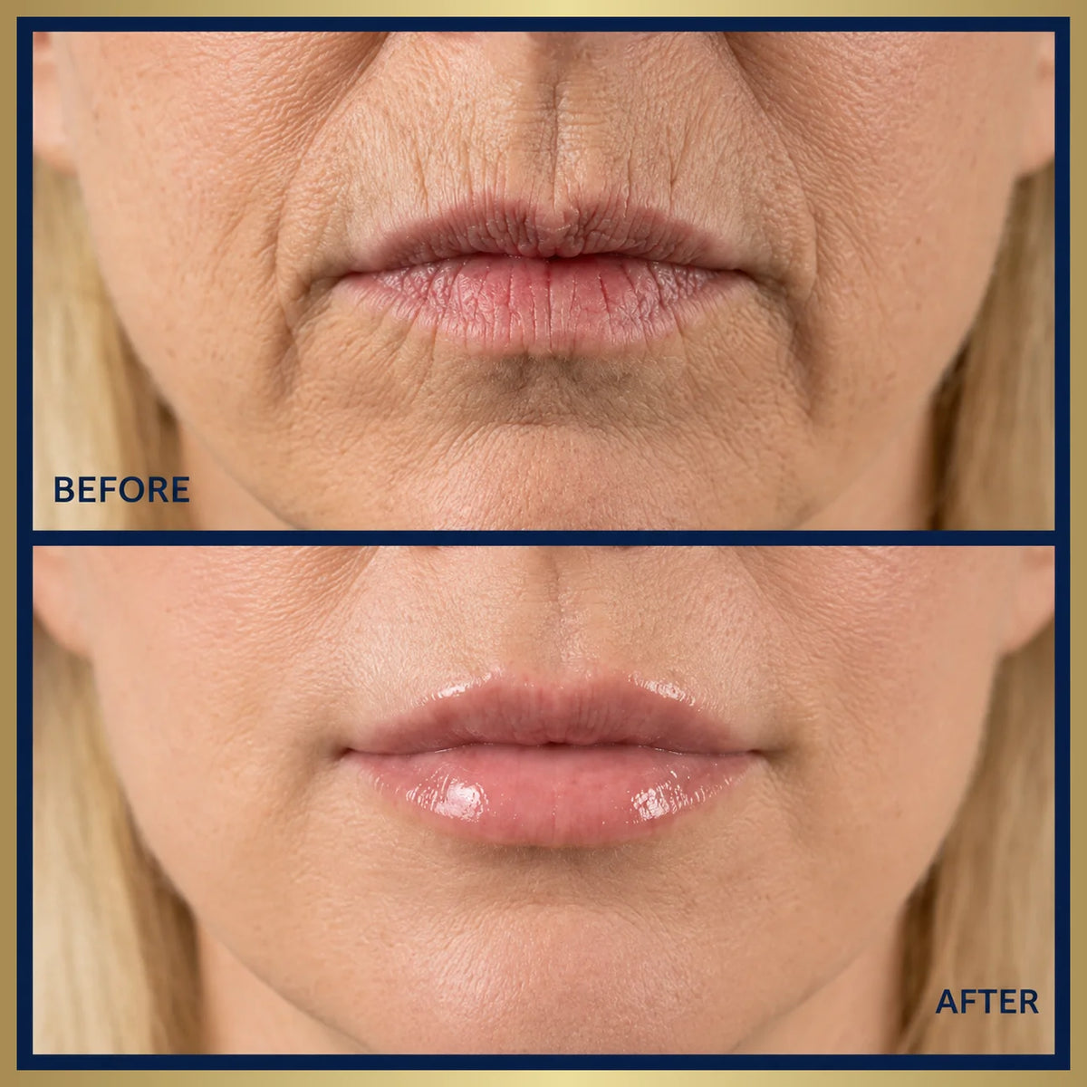 <i>Are Lip Wrinkles Aging You? Here's Why 50,000+ Women Switched To THIS</i>