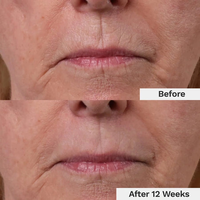 The Wait Is Over. Finally, a Solution Specifically for Lip Line Aging! Women Over 40, Listen Up.