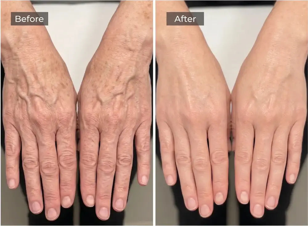 Erases the Look of Wrinkles In 60 Seconds