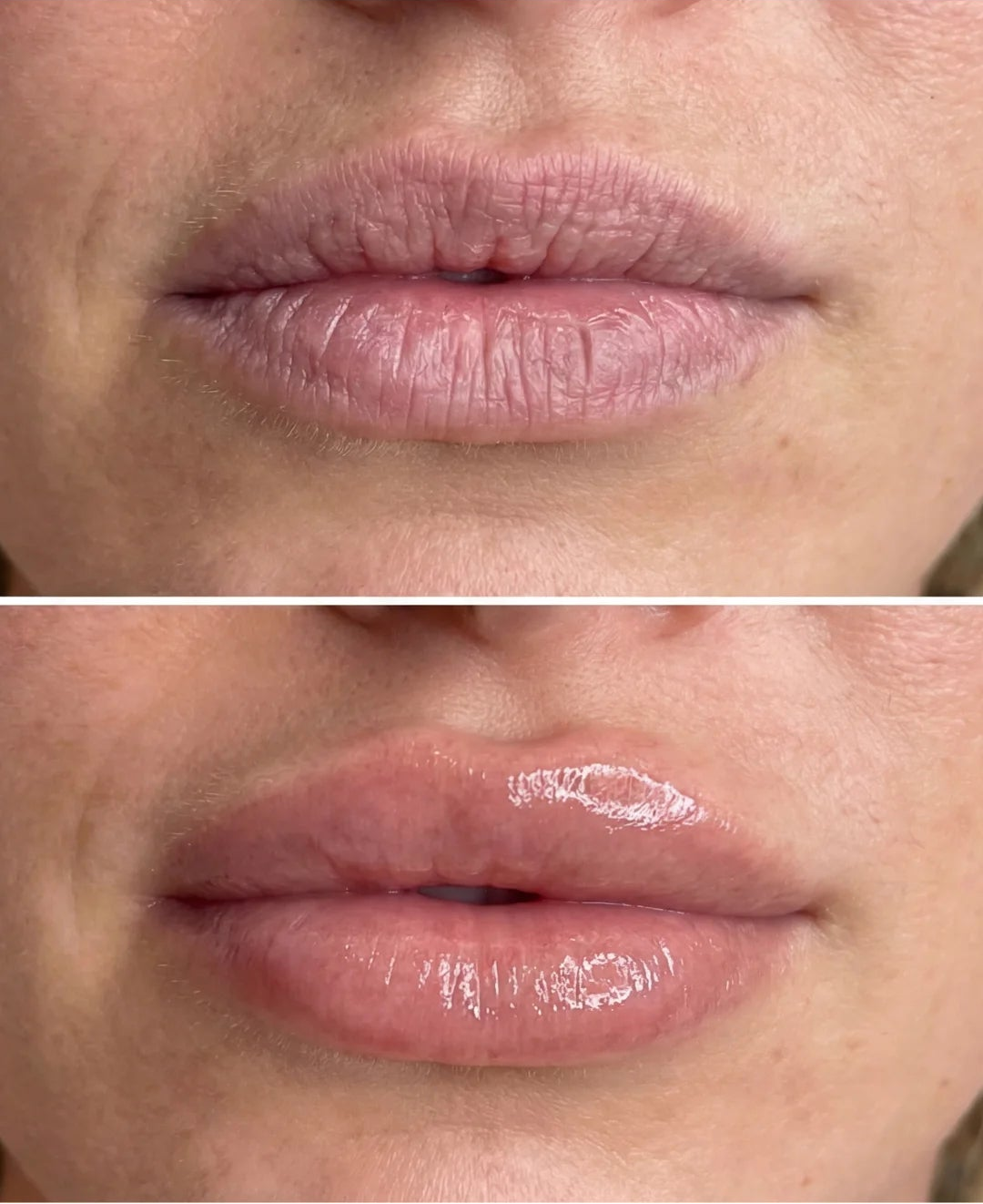Thinking About Lip Fillers? Here's Why 50,000+ Women Canceled Their Appointments