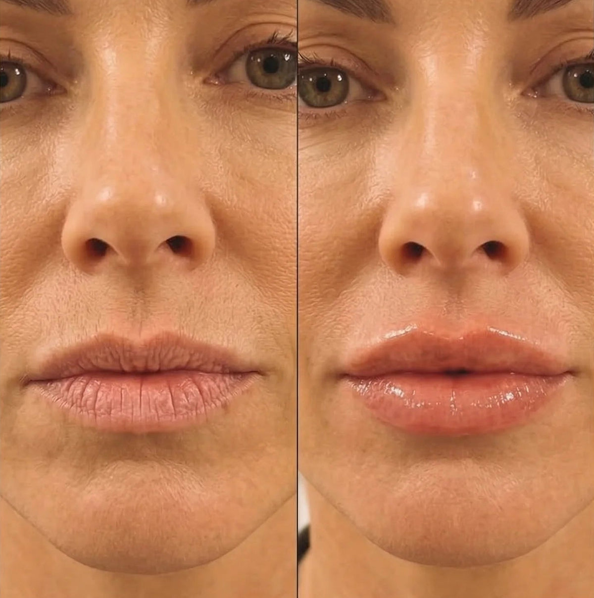 Thinking About Lip Fillers? Here's Why 50,000+ Women Canceled Their Appointments