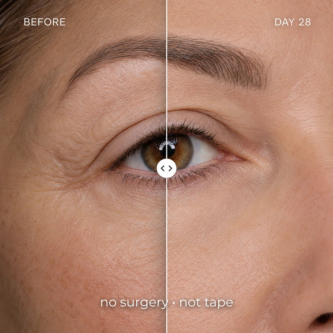 <i>Considering An Upper Bleph or Lid Lift? Here's Why 50,000+ Women Canceled Their Appointments</i>