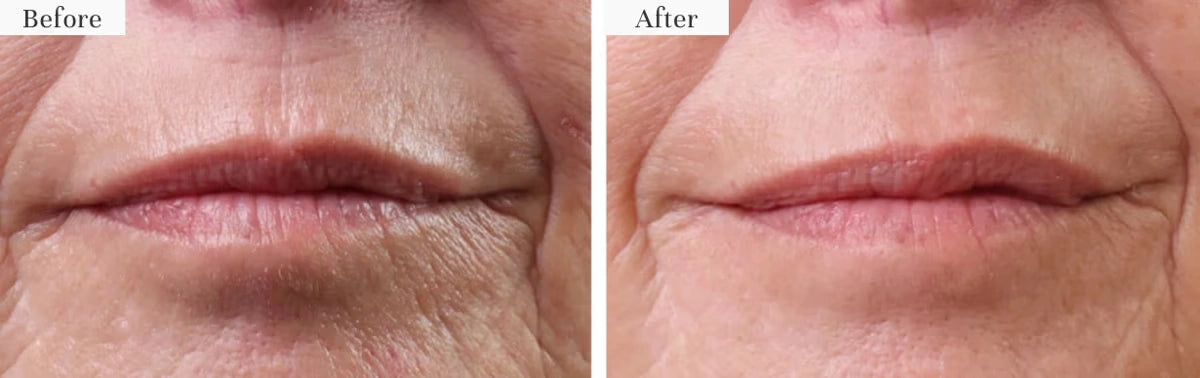 Before and after results