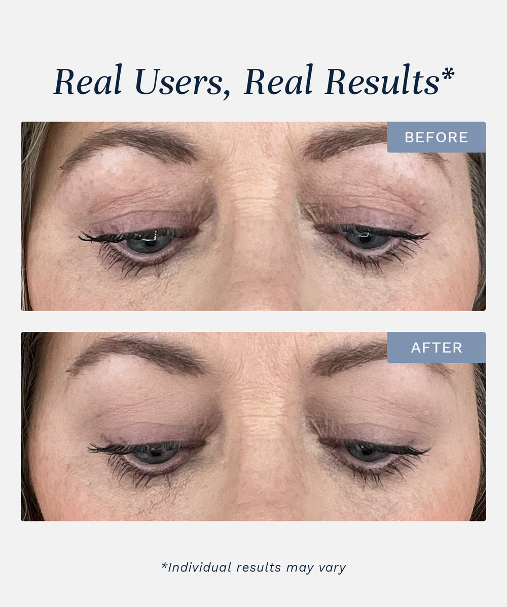 Lid Lifting Treatment -