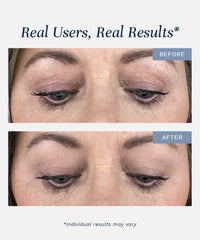 Lid Lifting Treatment -
