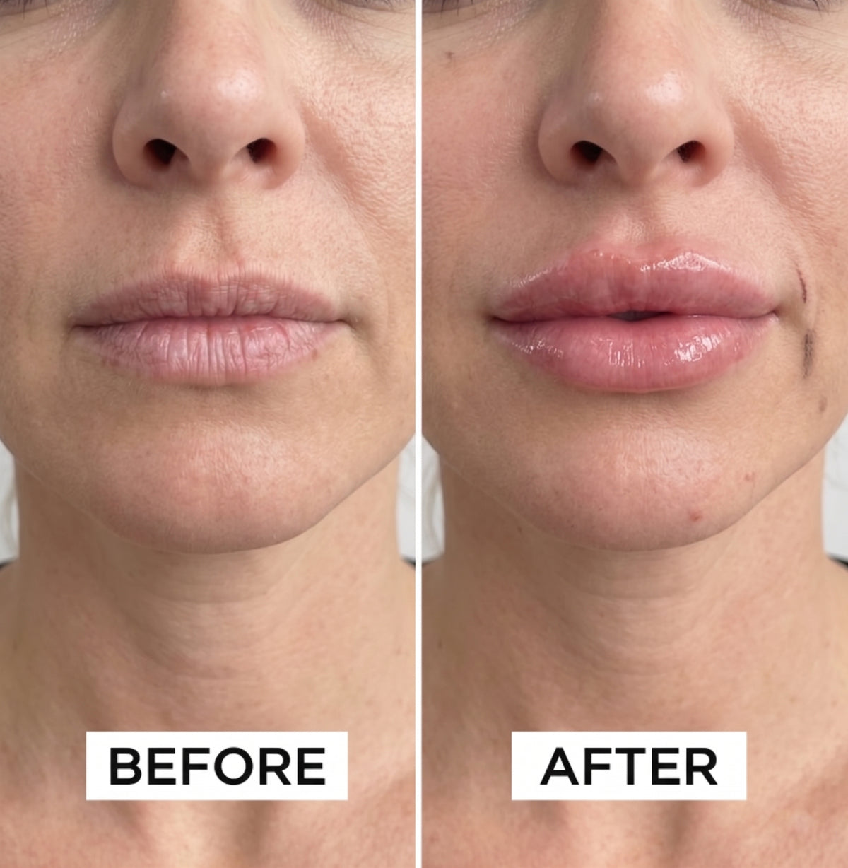 Thinking About Lip Fillers? Here's Why 50,000+ Women Canceled Their Appointments